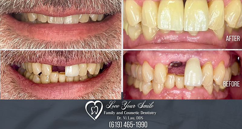Love Your Smile Dentistry | Periodontal Gum Disease, Dentures and Root Canals