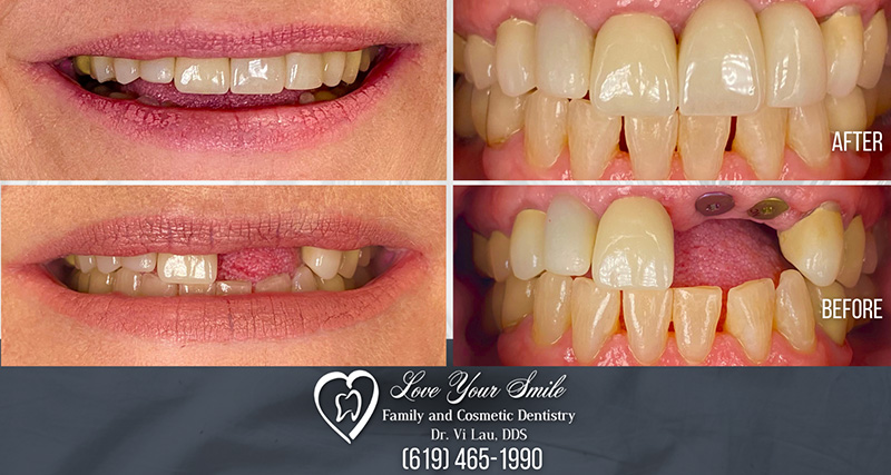 Love Your Smile Dentistry | Dental Fillings, Dental Bridges and Pediatric Dentistry