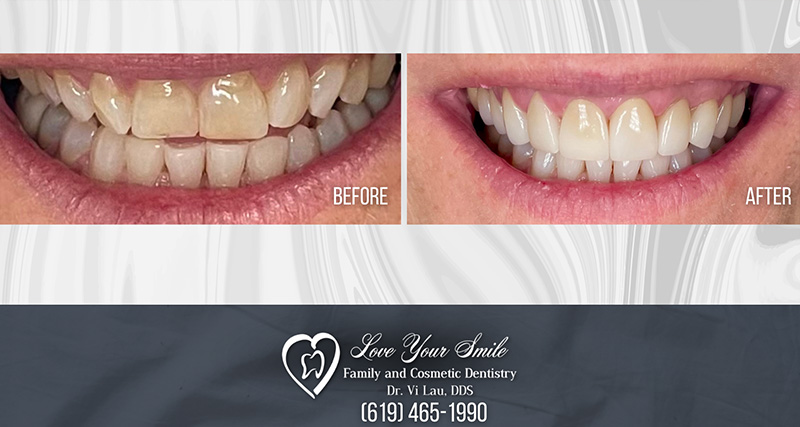 Love Your Smile Dentistry | All-on-4 reg , TMJ Disorders and Dental Cleanings