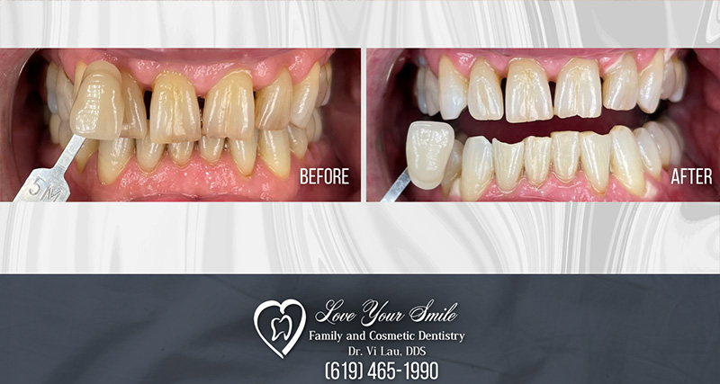 Love Your Smile Dentistry | Preventative Program, Oral Cancer Screening and Dentures