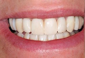 Love Your Smile Dentistry | Oral Cancer Screening, All-on-6 and TMJ Disorders